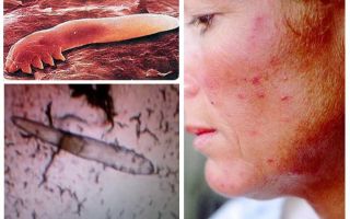 Pidocchi sottocutanei negli esseri umani sul corpo e sulla testa