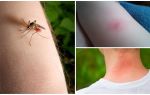 What is the difference between a mosquito bite and a bug or tick bite?