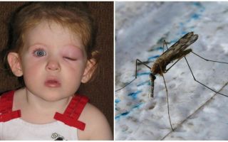 What to do if a child has a puffy eye after a mosquito bite