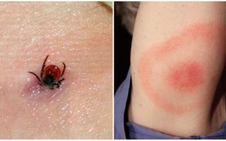 Tick-borne encephalitis - incubation period, symptoms and treatment