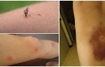 Why do bruises remain after mosquito bites?