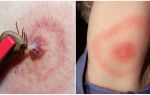 Was ist Lyme-Borreliose, seine Symptome, Behandlung und Foto