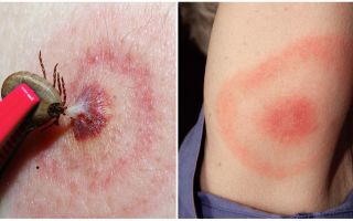 Was ist Lyme-Borreliose, seine Symptome, Behandlung und Foto