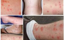 How do flea bites on human skin photo