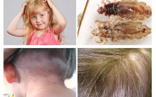 Pediculosis in kindergarten