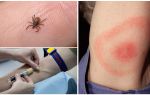 การตรวจเลือดสำหรับ borreliosis