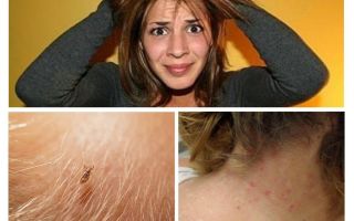 Prevenzione della pediculosi e della scabbia