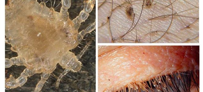 Pubic Lice Symptoms and Treatment