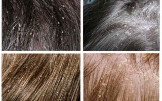 Head lice in childrens hair