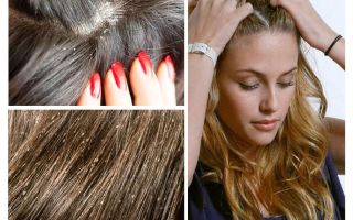 How to distinguish lice and nits from dandruff