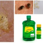 Cyclox remedy for bedbugs