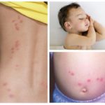 Bedbugs bite women and children