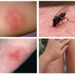 Picades de mosquits