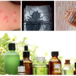 Remedies for bedbugs bites