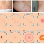 Types of insect bites