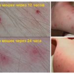 Picades de mosquits