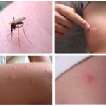 Mosquito bites