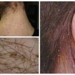 Types of Pediculosis