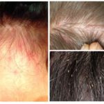 Lice in children-1