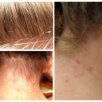 Lice in children