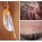 Danger of pediculosis