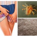 Pubic lice ในสตรี