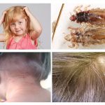 Pediculosis in children