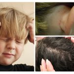 Signs of lice