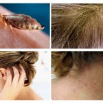 Symptome von Pediculosis