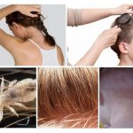 Signs of lice