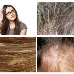 Symptoms of lice