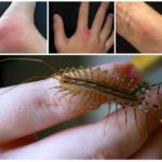 Centipede bite