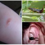 Earwig bite