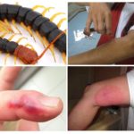 Scolopendra Bite