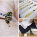 Bienengift Behandlung