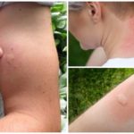 Quadre clínic típic d'una mossegada de mosquits