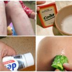 Remeis populars per a picades de mosquits