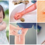 Primers auxilis per a picades de mosquits en nens