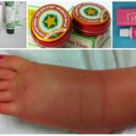 Treatment of leg swelling with natural remedies