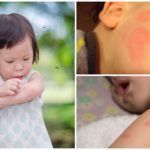 Mosquito bites in children