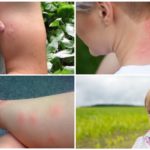 The reaction of the body to insect bites