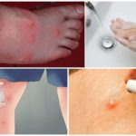 Accions per a picar mosquits