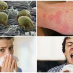 Allergie gegen Bettmilben