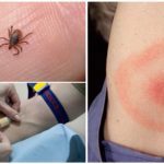 Bluttest für Borreliose nach einem Zeckenstich