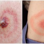 Lyme-Borreliose oder durch Zecken übertragene Borreliose