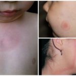 Borreliosis in children