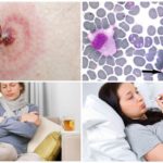 الوحيدات ehrlichiosis في البشر