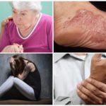 Symptoms of chronic stage of borreliosis