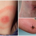 Bite encephalitis tick