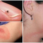 Tick-borne borreliosis